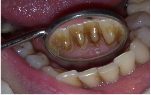 Detartraj ultrasunet & airflow Detartraj ultrasunet & airflow