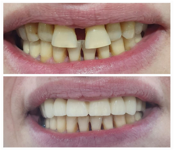 Tratament endodontic Tratament endodontic