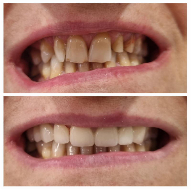 Punte din Zirconiu Punte din Zirconiu