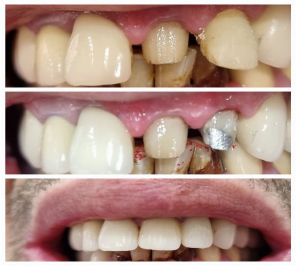 Tratament de canal Tratament de canal